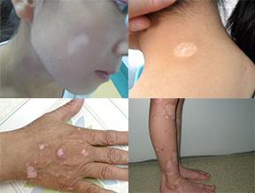 白癜风早期会有小米粒疙瘩吗,儿童白癜风早期治愈率90%