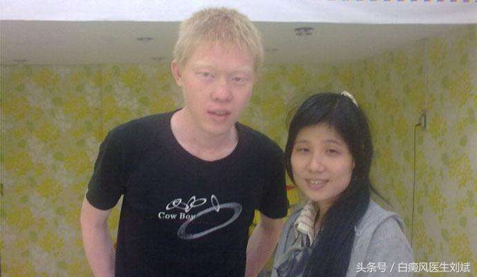 色素沉着会患白癜风吗,手上长白斑一定是白癜风吗