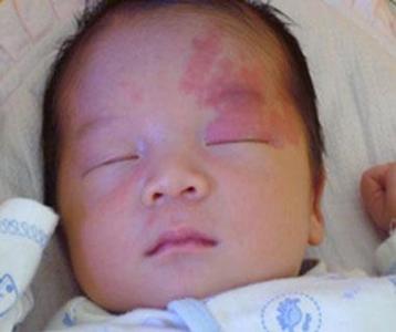 小孩身上有红斑是不是血管瘤,婴儿面部红斑痣与血管瘤怎么判断