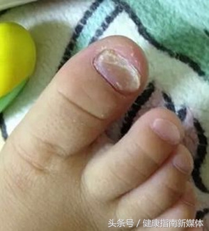 为什么三个月的婴儿都是灰指甲,指甲发黄警惕灰指甲