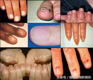 为什么三个月的婴儿都是灰指甲,指甲发黄警惕灰指甲