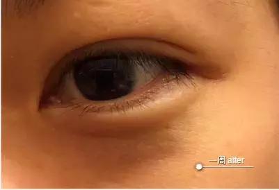 爆痘脱皮怎么快速解决,换季爆痘干燥