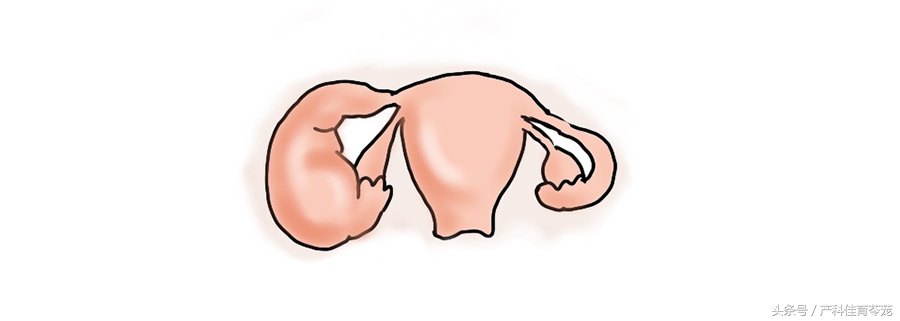 治疗盆腔炎要趁早！不然有大事发生