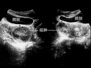 超声能查出子宫是否粘连吗,三维超声查宫腔粘连多少钱