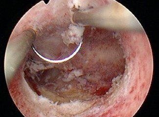 超声能查出子宫是否粘连吗,三维超声查宫腔粘连多少钱