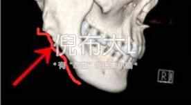 削骨整形的最佳方法,磨骨整形和削骨