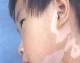 308和uvb哪个治疗白癜风好,uvb治疗白癜风