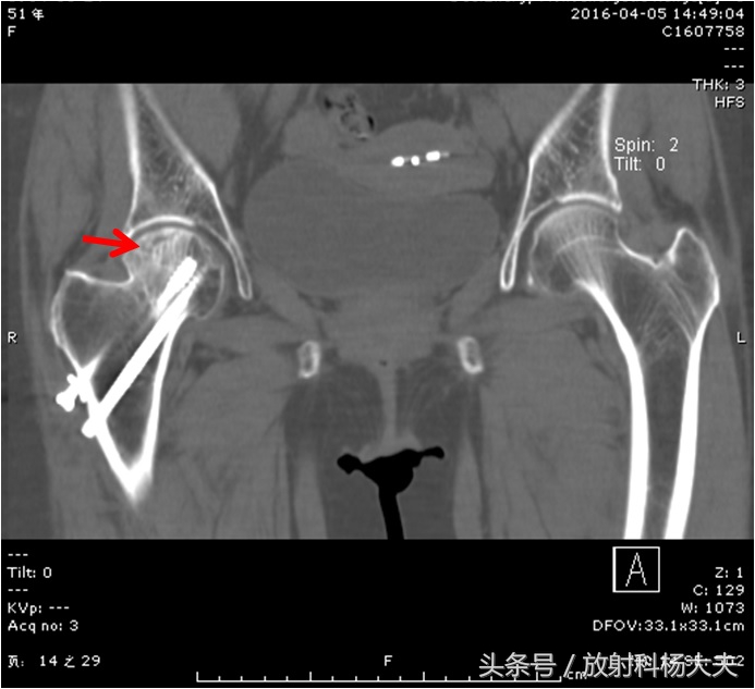 股骨骨折手术五个月拄拐杖走路疼,股骨头坏死手术后一个月腿弯疼