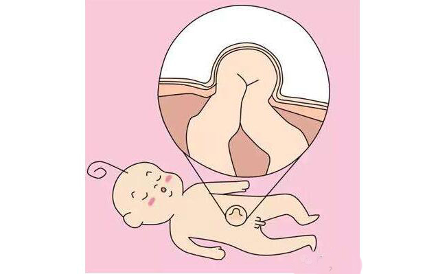 新生儿脐疝怎么护理,小儿脐疝脐带四周会鼓起吗