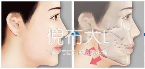 下颌角削多了变成马脸怎么修复,下颌角削骨有哪几种切法