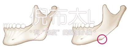 下颌角削多了变成马脸怎么修复,下颌角削骨有哪几种切法