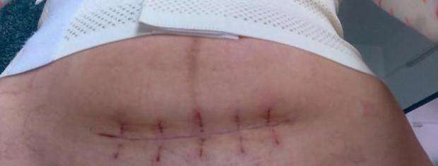 一层层,一刀刀切开孕妇肚子,剖腹产并不是你想象的那么简单