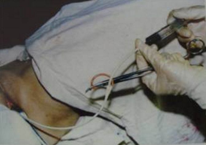 正常输卵管有多长多粗,输卵管有多长多粗