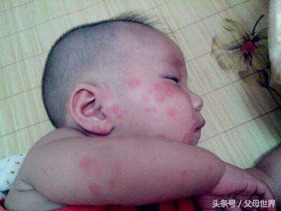 蛀牙会导致面瘫吗,蛀牙会引起偏头痛吗