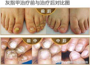 为什么三个月的婴儿都是灰指甲,指甲发黄警惕灰指甲