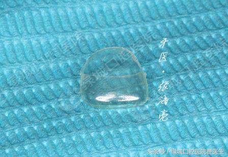 乳前牙透明冠修复视频,乳前牙残根修复