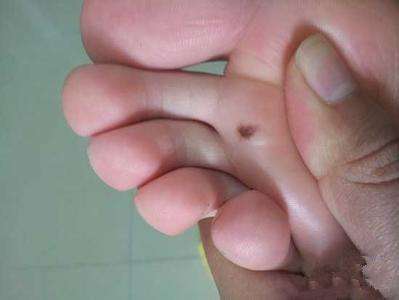 宫颈癌子宫癌阴道癌都有哪些症状,你听说过夫妻癌吗