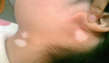 准妈妈实用技能:如何判断宝宝得了蛔虫病附治疗方式