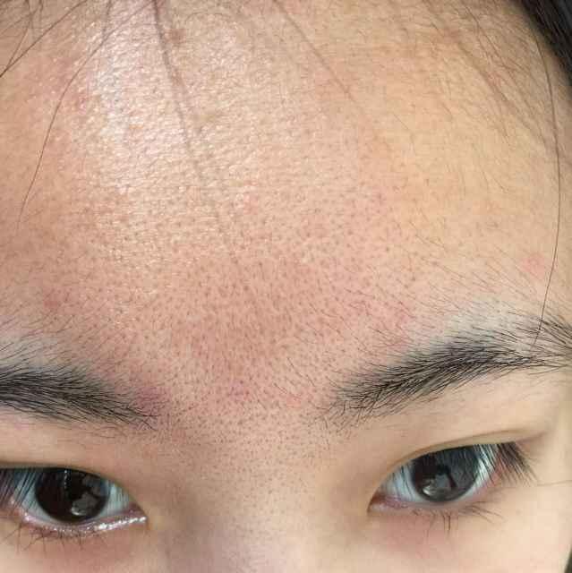 脸颊额头毛孔粗大补水就会改善吗,额头毛孔粗大如何改善学生