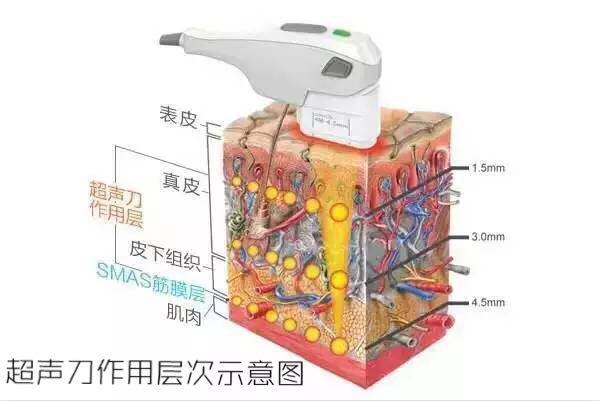 超声刀美容危害,正版超声刀与山寨超声刀的区别