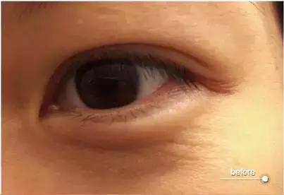 爆痘脱皮怎么快速解决,换季爆痘干燥