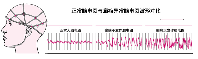 早产儿脑电图异常说明什么,轻微脑电图异常是什么原因