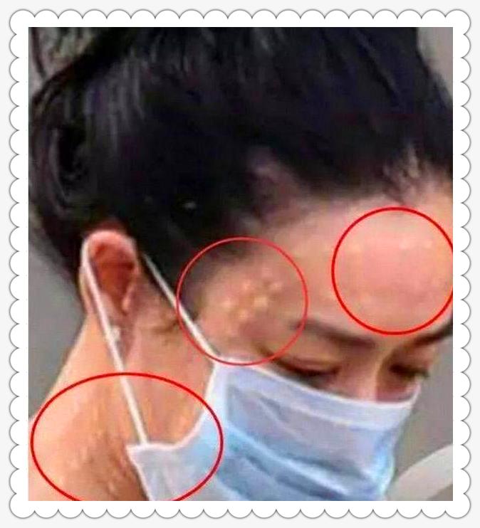 钟丽缇美白针,钟丽缇刮痧脸部