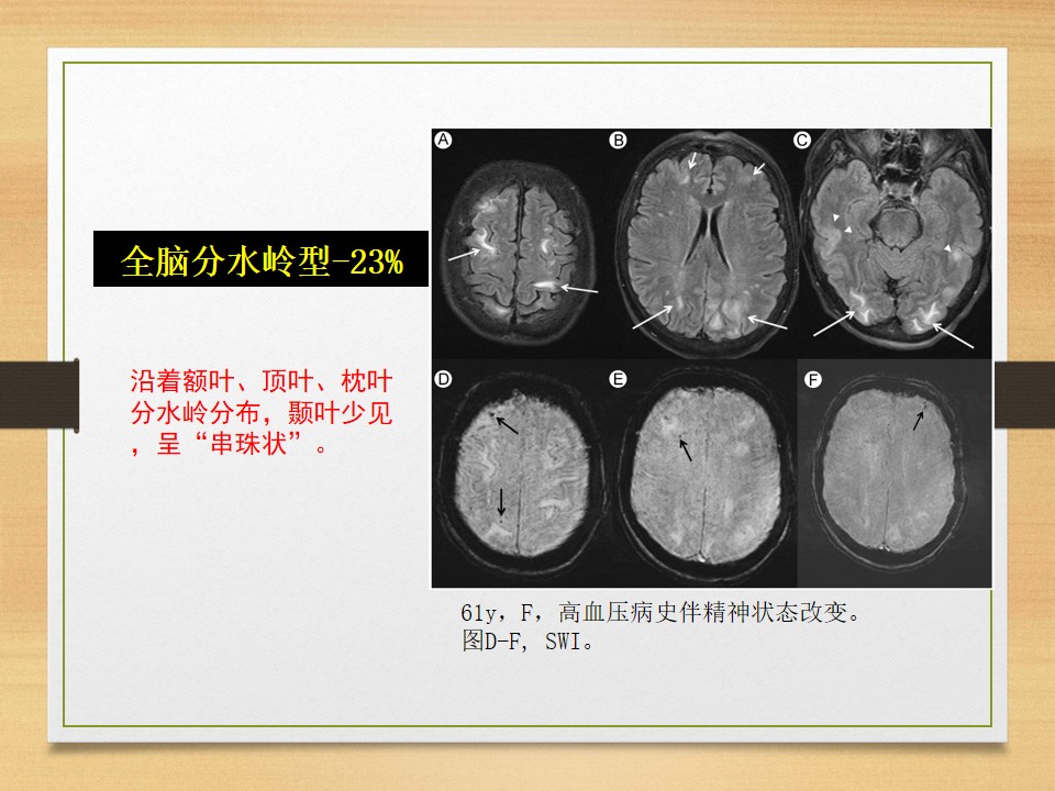 可逆性后部白质脑病综合征中央型,可逆性后部白质脑病综合征啥症状