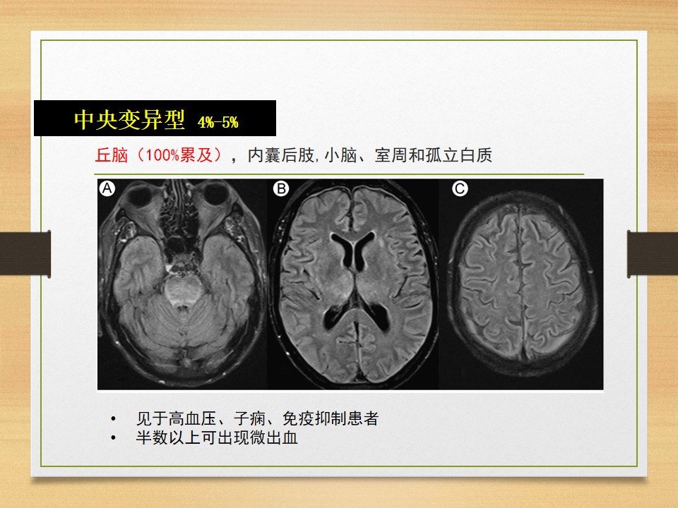 可逆性后部白质脑病综合征中央型,可逆性后部白质脑病综合征啥症状