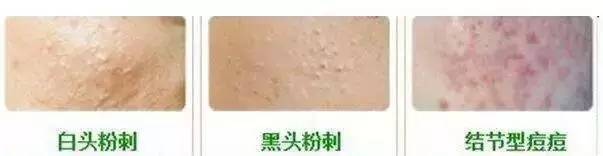 黑头粉刺满是痘痘,粉刺和痘痘肌的区别