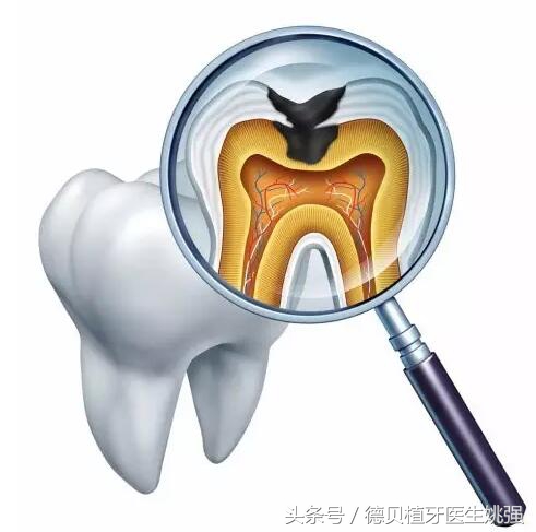 补牙竟然不能一次完成？