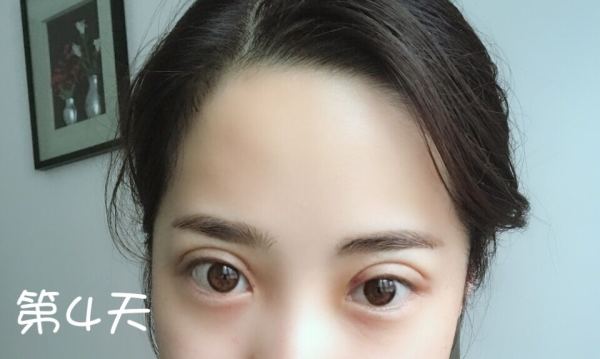 鼓起勇气做了个双眼皮,鼓起勇气做了医美