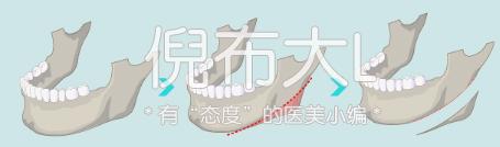 下颌角削多了变成马脸怎么修复,下颌角削骨有哪几种切法