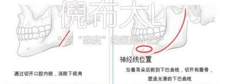 下颌角削多了变成马脸怎么修复,下颌角削骨有哪几种切法