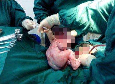 一层层,一刀刀切开孕妇肚子,剖腹产并不是你想象的那么简单