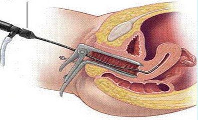 超声能查出子宫是否粘连吗,三维超声查宫腔粘连多少钱