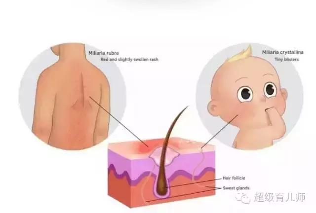 宝宝起痱子什么办法好得快,宝宝起痱子了怎么快速消除