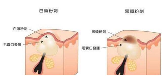 最近脸上疯狂长痘是因为换季吗,一换季脸就起痘