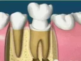 大名“根管治疗”，小名“抽神经”，诊疗要求：全冠保护