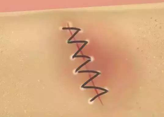 小孩子脸上摔伤擦什么不留疤,小孩摔伤了怎么处理不会留疤