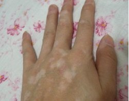 治疗白癜风光疗有副作用吗,儿童白癜风308激光一周几次最好