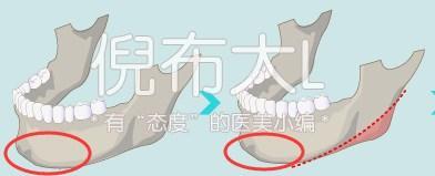 下颌角削多了变成马脸怎么修复,下颌角削骨有哪几种切法