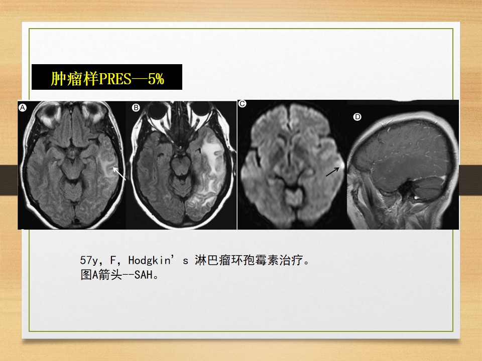 可逆性后部白质脑病综合征中央型,可逆性后部白质脑病综合征啥症状