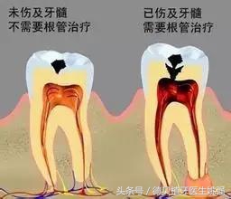 补牙竟然不能一次完成？