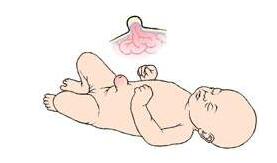 新生儿脐疝怎么护理,小儿脐疝脐带四周会鼓起吗