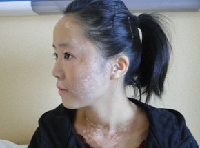 治疗白癜风光疗有副作用吗,儿童白癜风308激光一周几次最好