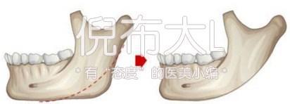 下颌角削多了变成马脸怎么修复,下颌角削骨有哪几种切法