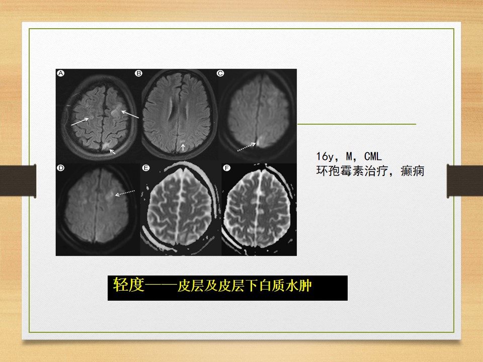 可逆性后部白质脑病综合征中央型,可逆性后部白质脑病综合征啥症状