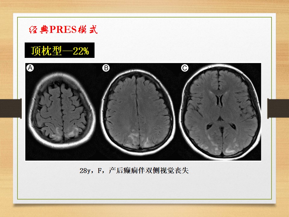 可逆性后部白质脑病综合征中央型,可逆性后部白质脑病综合征啥症状