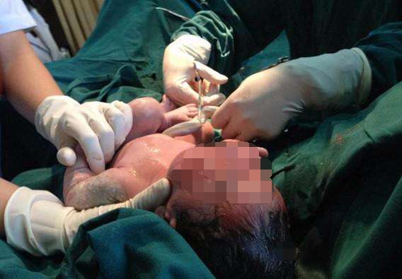 一层层,一刀刀切开孕妇肚子,剖腹产并不是你想象的那么简单